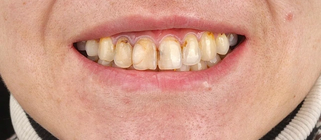 Протезирование верхнего и нижнего ряда, установка виниров